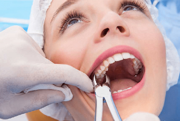 Tooth Extraction